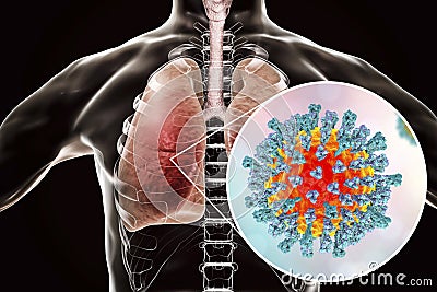 Measles viruses in human respiratory system Stock Photo