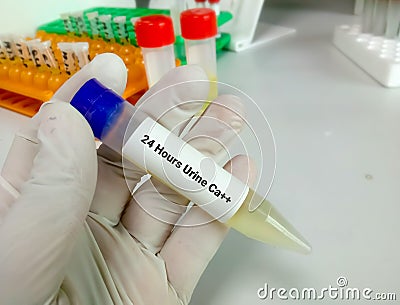 Measurement of the concentration of 24 hours urine calcium. Stock Photo