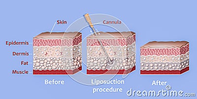 Mechanism of liposuction. Suction-assisted liposuction. Stock Photo