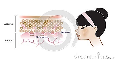 The mechanism of melasma skin vector. Infographic illustration of woman face. Vector Illustration