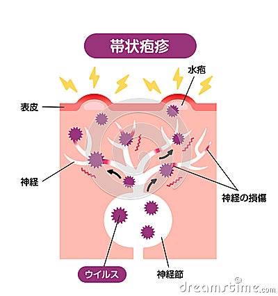 Mechanism of shingles ( herpes zoster ) vector illustration Vector Illustration