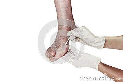 Medecin, valgus bunion, leg with deformation valgus hallux Bunion, Stock Photo