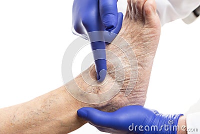 Medic pointing at varicose vein Stock Photo