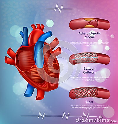 Medical Banner Atherosclerosis Treatment Methods Vector Illustration