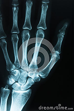 Medical xray scan of a hand Stock Photo