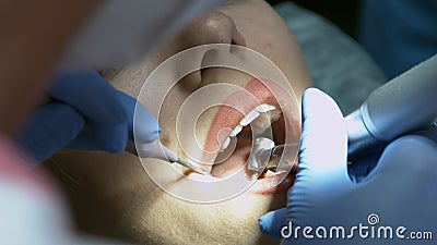 Medical dentist procedure of teeth polishing with cleaning from dental deposit and odontolith Stock Photo