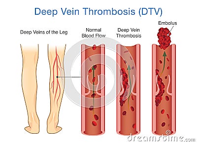 Medical Diagram of Deep Vein Thrombosis at leg area. Vector Illustration