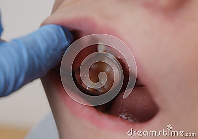 Medical examination of teeth using a mirror by a dentist. Caries, tooth damage. Stock Photo