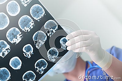 Medical experts studied the EEG condition of the patient Stock Photo
