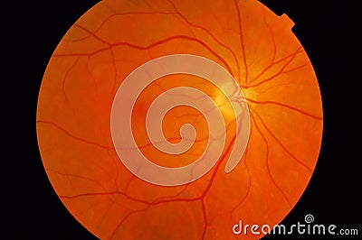 Medical fundus photo of macula Stock Photo