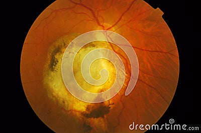 Medical Fundus photo of retinal patology Stock Photo