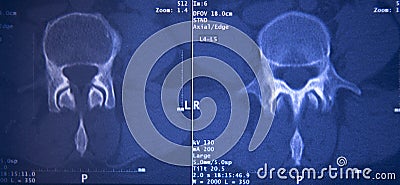 Medical hips spine pelvis MRI scan Stock Photo