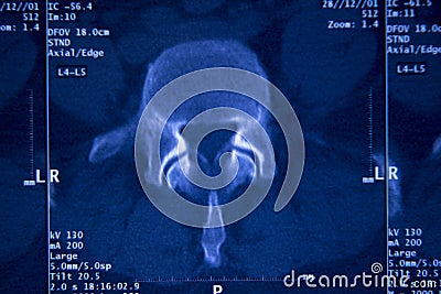 Medical hips spine pelvis MRI scan Stock Photo