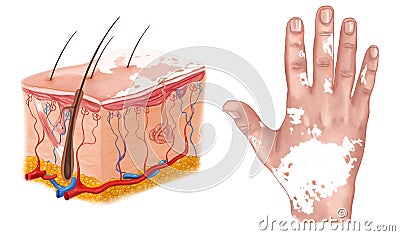 Medical Illustration of the effects of vitiligo Cartoon Illustration