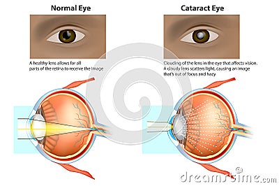 Medical illustration of a normal eye and an eye with a cataract, Vector Illustration