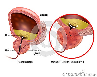 Medical illustration showing Benign prostatic hyperplasia BPH and Normal prostate. Prostate gland enlargement Vector Illustration