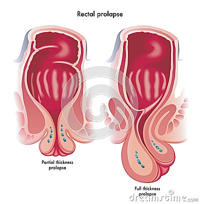 Medical illustration showing two types of rectal prolapse Vector Illustration