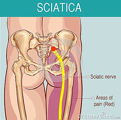 Medical illustration of symptoms of sciatica Vector Illustration