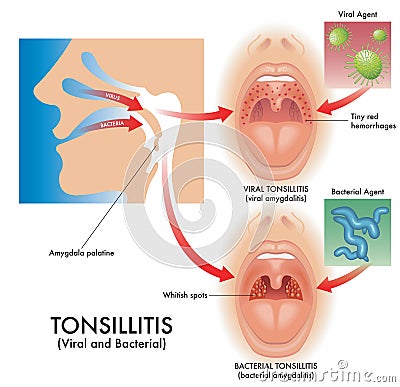 Medical Illustration Of Viral And Bacterial Tonsillitis Vector Illustration