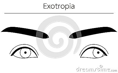 Medical illustrations, diagrammatic line drawings of eye diseases, strabismus and exotropia Cartoon Illustration