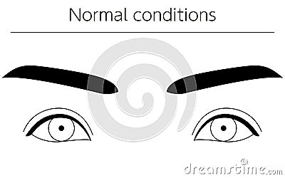 Medical illustrations, diagrammatic line drawings of eye diseases, strabismus and normal conditions Cartoon Illustration