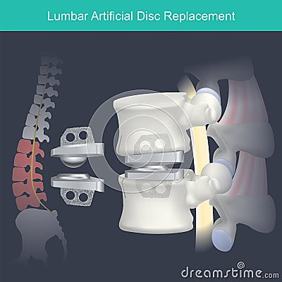 Lumbar Artificial Disc Replacement. Human bone anatomy. Stock Photo