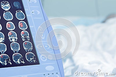 Medical scan of human brain injury Stock Photo