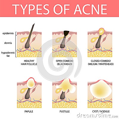 Medical vector illustration of different types of acne on human skin. Appearance of pimples in hair follicle Vector Illustration