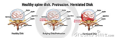 Healthy spine disk. Protrusion. Herniated Disk. Bulging Disk. The anatomical structure of the spine. Compressed nerve endings. Cartoon Illustration