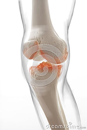 Medically accurate representation of an arthritic knee joint, knee meniscus, human leg, 3d illustration Stock Photo