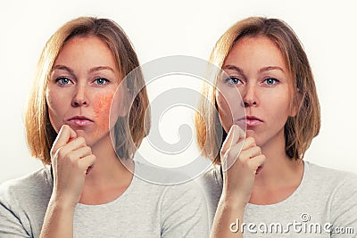 Medicine, cosmetology, rosacea. Blonde with rosacea-inflamed cheeks and blood vessels. Before and after Stock Photo