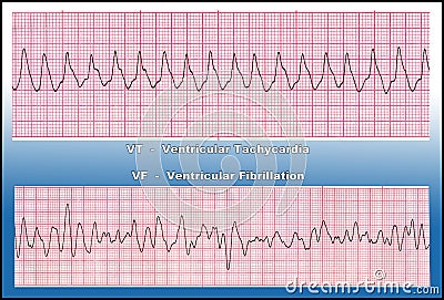 Medicine - Deadly Heart Arrhythmia - VT & VF Royalty Free Stock