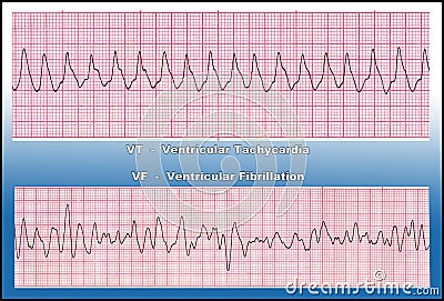 Medicine - Deadly Heart Arrhythmia - VT & VF Stock Photo