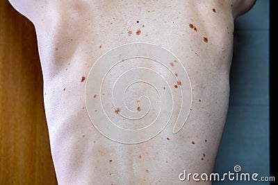 Melanocytic nevus, some of them dyplastic or atypical, on a caucasian man of 36 years old Stock Photo