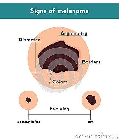Melanoma ABCDE signs. Vector illustration of skin patch with skin cancer Vector Illustration