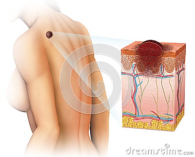 Melanoma on the back Stock Photo