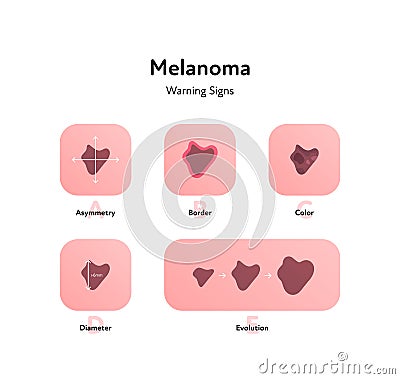 Melanoma cancer anatomical infographic poster. Vector flat medical illustration. Warning signs of tumor disease. Asymmetry, border Vector Illustration