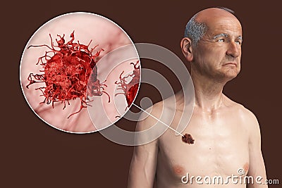 Melanoma, a cancer developing from pigment-containing cells melanocytes Cartoon Illustration