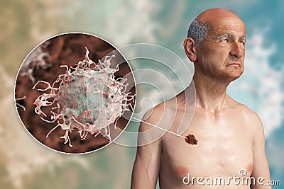 Melanoma, a cancer developing from pigment-containing cells melanocytes Cartoon Illustration
