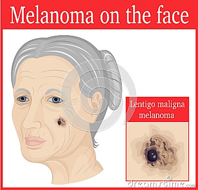 Melanoma on the cheek Vector Illustration