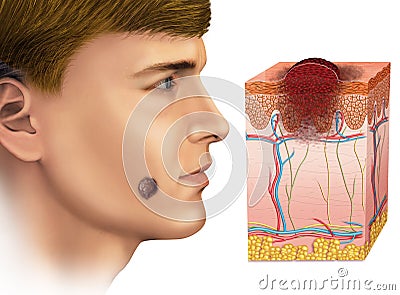 Melanoma on the face Stock Photo