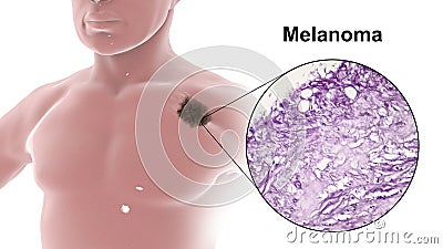 Melanoma on a male body Cartoon Illustration