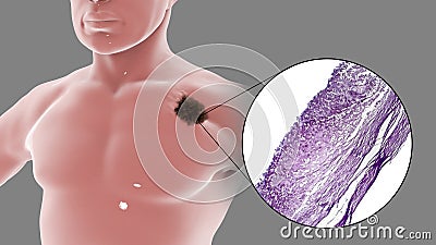 Melanoma on a male body Cartoon Illustration