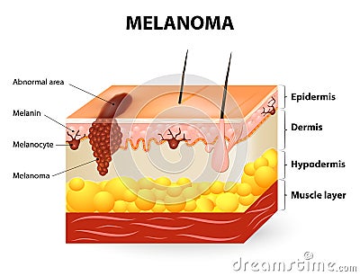 Melanoma or skin cancer Vector Illustration