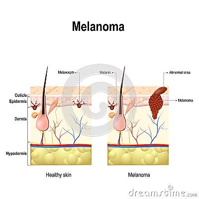 Melanoma or skin cancer. Vector Illustration