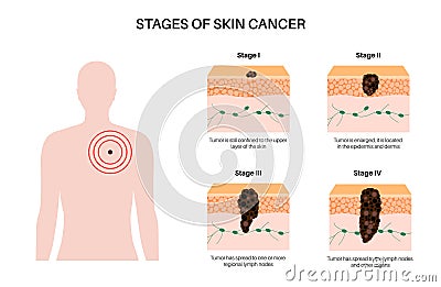 Melanoma stages poster Vector Illustration