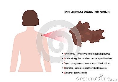 Melanoma warning signs Vector Illustration