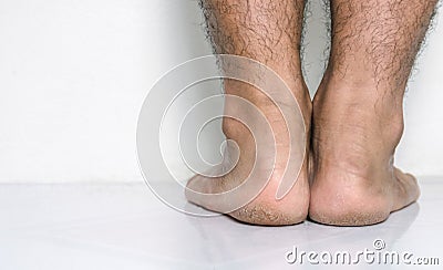 Men a feet skin cracked heels Stock Photo