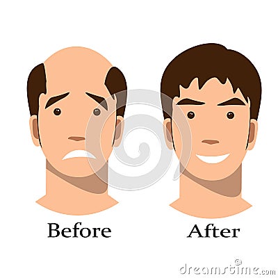 Men thinning hair treatment before and after Vector Illustration