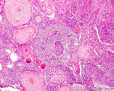 Meningioma. Psammoma bodies Stock Photo